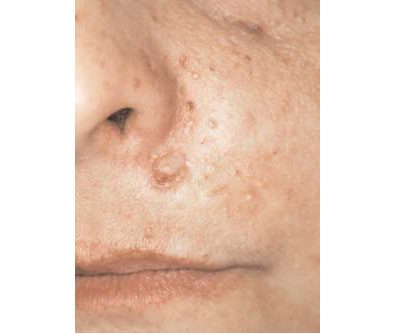 cancer cutane baso-cellulaire