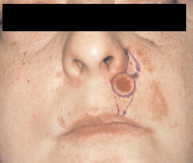 cancer cutane baso-cellulaire