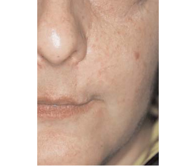 cancer cutane baso-cellulaire