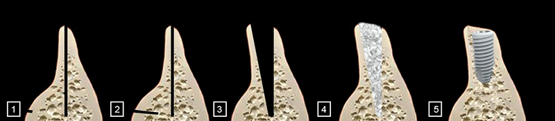 vue en coupes verticale de la mandibule