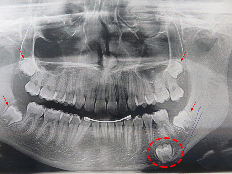 Procédure et coût de l'extraction des dents de sagesse - Dentakay