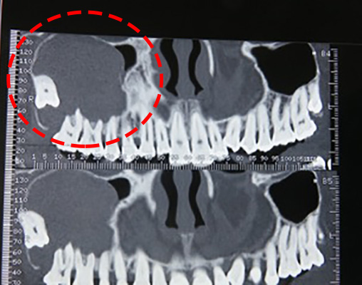 Scanner du maxillaire supérieur présentant un kyste développé dans les sinus aux dépends d'une dent ectopique