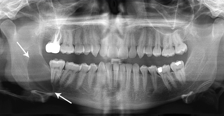 exemple de kyste mandibule