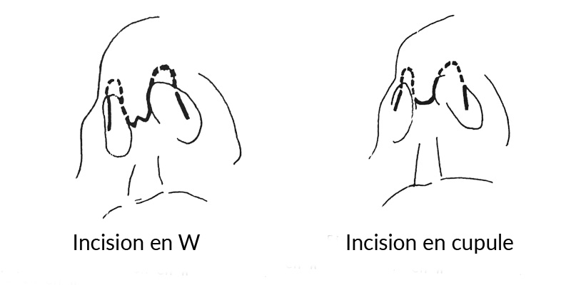 Incisions en rhinoplastie