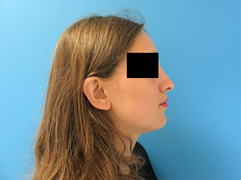 exemple rhinoplastie avant après