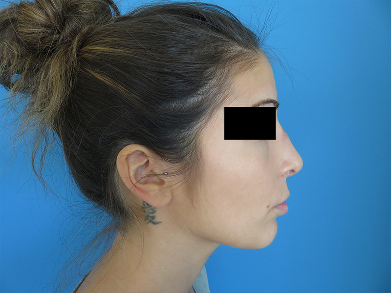 exemple rhinoplastie avant après