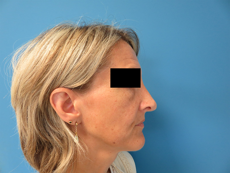 exemple rhinoplastie avant après