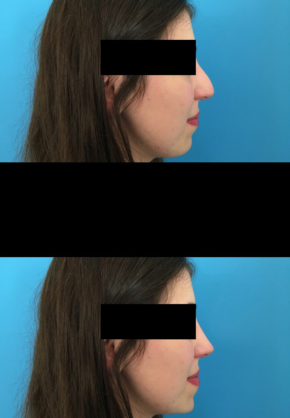 Rhinoplastie : Simulation pré et post opératoire