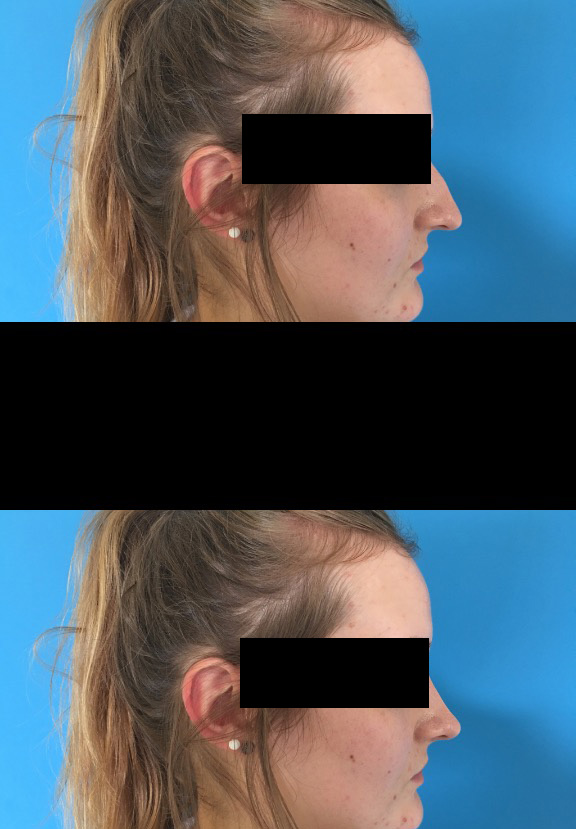Rhinoplastie : Simulation pré et post opératoire
