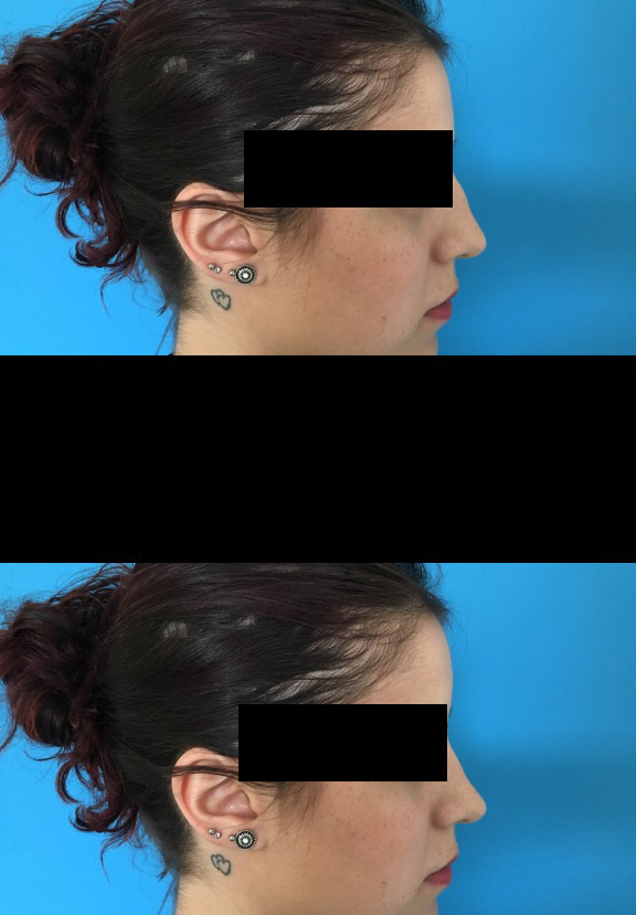 Rhinoplastie : Simulation pré et post opératoire