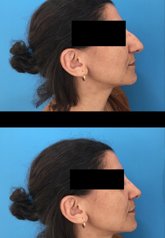 Rhinoplastie : Simulation pré et post opératoire