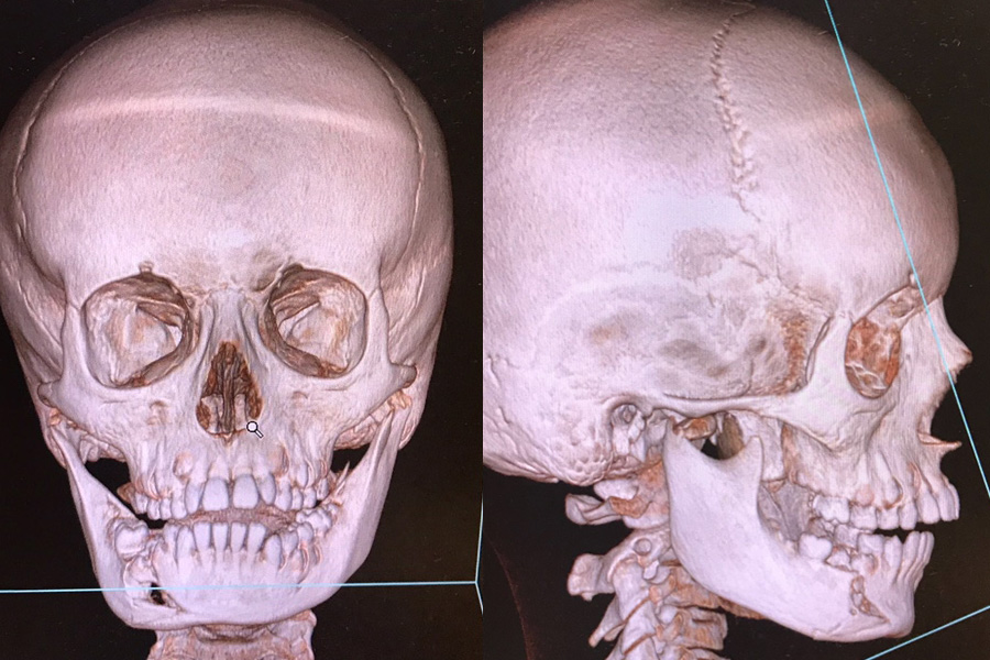 scanner de fracture de la mandibule