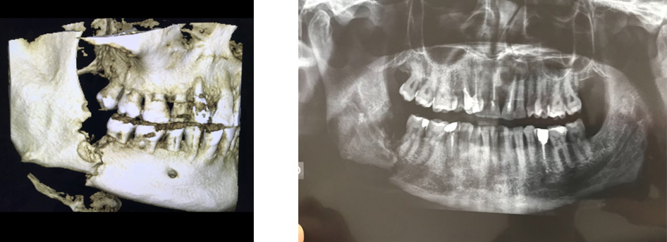 radio de fracture de la mandibule