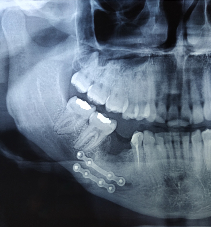 radio de fracture de la mandibule après intervention